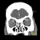 Ophthalmic artery, dilated: CT - Computed tomography
