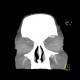 Ophthalmic artery, dilated: CT - Computed tomography