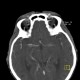 Ophthalmic artery, dilated: CT - Computed tomography