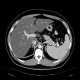 Liver steatosis: CT - Computed tomography