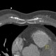 Sternal foramen: CT - Computed tomography