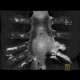 Sternal foramen, MIP: CT - Computed tomography