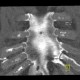 Sternal foramen, MIP: CT - Computed tomography