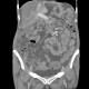 Venous congestion, thrombosis of superior mesenteric vein, ascites, steatosis of liver: CT - Computed tomography