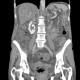 Venous congestion, thrombosis of superior mesenteric vein, ascites, steatosis of liver: CT - Computed tomography