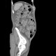 Venous congestion, thrombosis of superior mesenteric vein, ascites, steatosis of liver: CT - Computed tomography
