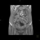 Venous congestion, thrombosis of superior mesenteric vein, ascites, steatosis of liver: CT - Computed tomography