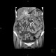 Venous congestion, thrombosis of superior mesenteric vein, ascites, steatosis of liver: CT - Computed tomography