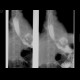 Gastrectomy, esophago-entero-anastomosis: RF - Fluoroscopy