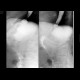 Stomach resection, Billroth II, hiatal hernia: RF - Fluoroscopy