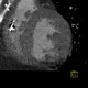 Subendocardial infarct of posterior wall of the left ventricle: CT - Computed tomography