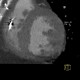 Subendocardial infarct of posterior wall of the left ventricle: CT - Computed tomography