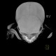 Metopic suture: CT - Computed tomography