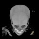 Metopic suture: CT - Computed tomography
