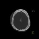 Metopic suture: CT - Computed tomography
