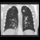 Sarcoidosis, pulmonary: CT - Computed tomography