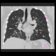 Sarcoidosis, pulmonary: CT - Computed tomography