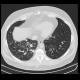 Sarcoidosis, pulmonary: CT - Computed tomography