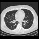 Sarcoidosis, pulmonary: CT - Computed tomography