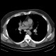 Sarcoidosis, pulmonary: CT - Computed tomography
