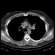 Sarcoidosis, pulmonary: CT - Computed tomography
