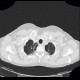 Sarcoidosis, pulmonary sarcoidosis, stage IV: CT - Computed tomography