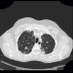 Sarcoidosis, pulmonary sarcoidosis, stage IV: CT - Computed tomography