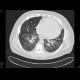 Sarcoidosis, second stage: CT - Computed tomography