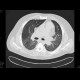 Sarcoidosis, second stage: CT - Computed tomography