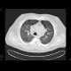 Sarcoidosis, second stage: CT - Computed tomography
