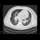 Sarcoidosis, second stage: CT - Computed tomography