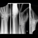 Scaphoid fracture, non-union, osteosynthesis with spongiosa: X-ray - Plain radiograph
