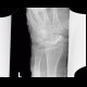 Scaphoid fracture, non-union, osteosynthesis with spongiosa: X-ray - Plain radiograph