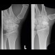 Scaphoid fracture, non-union, osteosynthesis with spongiosa: X-ray - Plain radiograph