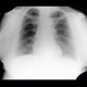 Diaphragmatic lobulation: X-ray - Plain radiograph
