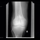 Fracture of patella, hardware failure: X-ray - Plain radiograph