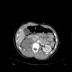 Severed kidney, kidney trauma: CT - Computed tomography
