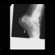 Sever's disease, calcaneal apophysitis: X-ray - Plain radiograph