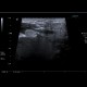 Sialolithiasis, salivary stone, submandibular gland, Wharton's duct: US - Ultrasound
