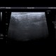 Sicca syndrom, salivary glands: US - Ultrasound