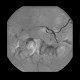 Bleeding in sigmoid colon, embolization: AG - Angiography