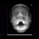 Acute sinusitis, Waters view: X-ray - Plain radiograph