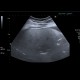Steatosis of liver, steatosis hepatis, fatty liver, parenchymal sparing: US - Ultrasound