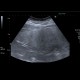 Steatosis of liver, steatosis hepatis, fatty liver, parenchymal sparing: US - Ultrasound