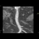 Stenosis of the superior mesenteric artery, AMS: CT - Computed tomography