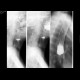 Stenosis of oesophagus: RF - Fluoroscopy