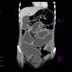 Crohn's disease, stenosis, prestenotic dilatation, CT enteroclysis, first examination: CT - Computed tomography