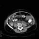 Crohn's disease, stenosis, rupture, routine CT at 3 years: CT - Computed tomography