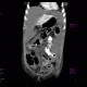 Crohn's disease, stenosis, rupture, routine CT at 3 years: CT - Computed tomography