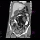 Crohn's disease, stenosis, rupture, routine CT at 3 years: CT - Computed tomography